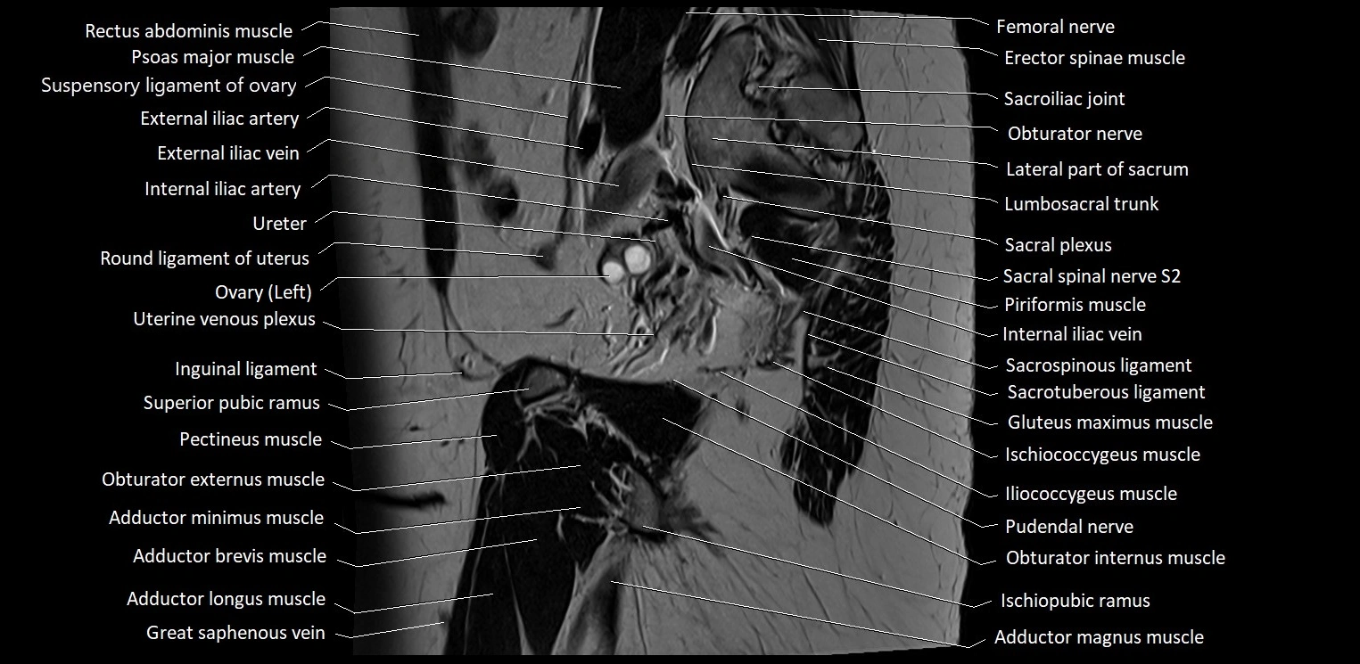 Sagittal cross sectional anatomy of female pelvis (MRI 3T) image 34.webp